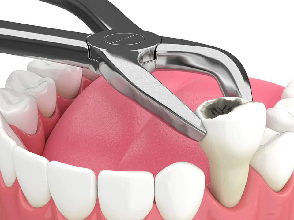 Tooth extractions in Greenville, WI at Westhill Dental.