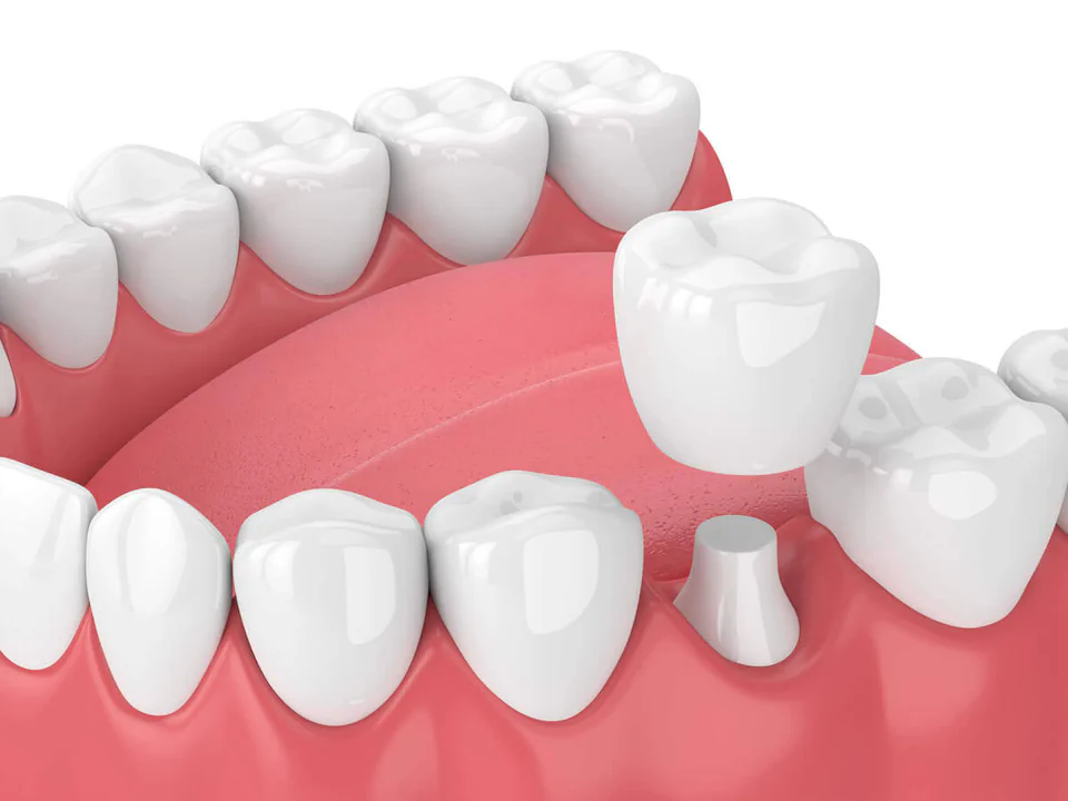 Dental crowns and bridges in Greenville, WI at Westhill Dental.