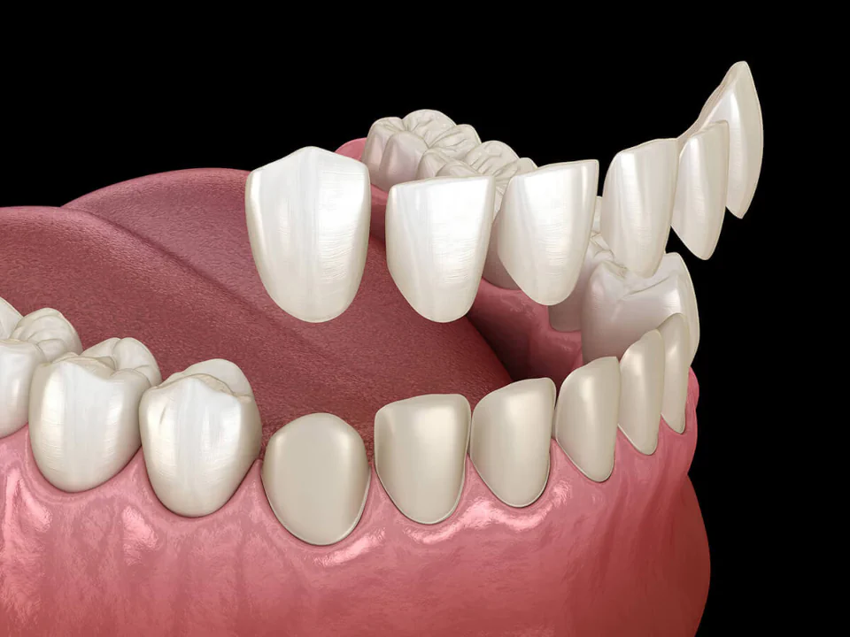 Dental veneers in Greenville, WI at Westhill Dental.