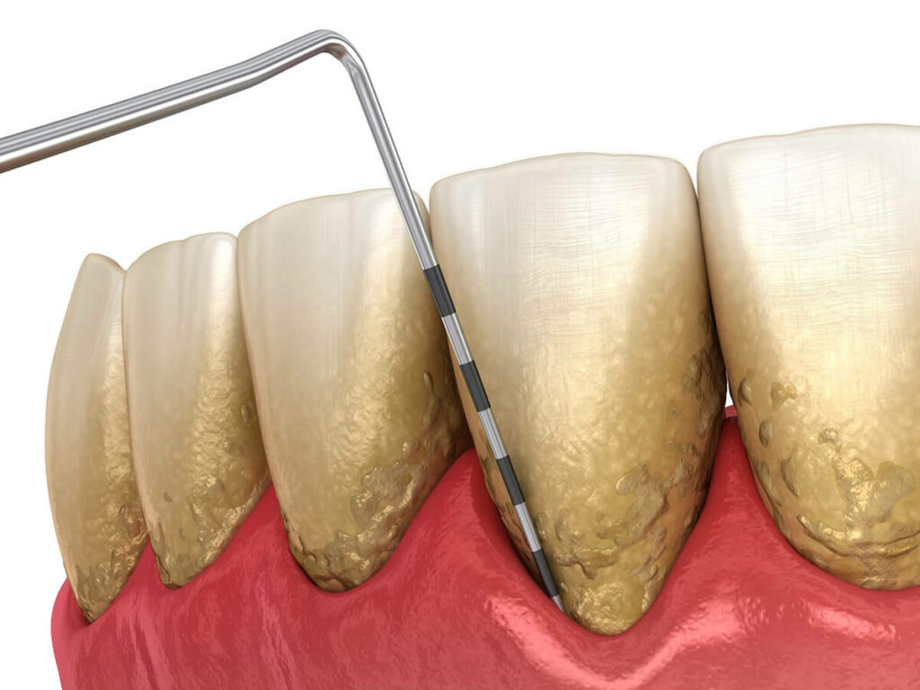 Close-up 3D illustration of teeth with plaque buildup along the gum line, with a dental probe indicating the presence of tartar, highlighting the need for periodontal treatment.