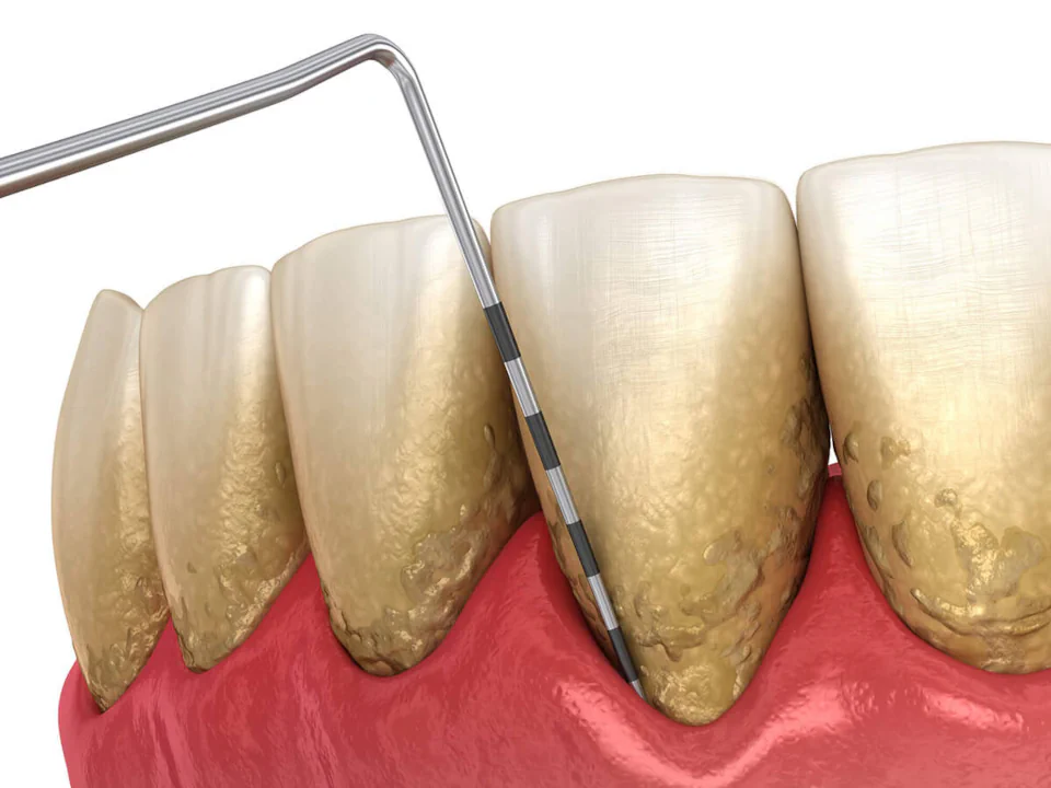 Gum disease treatment in Greenville, WI at Westhill Dental.