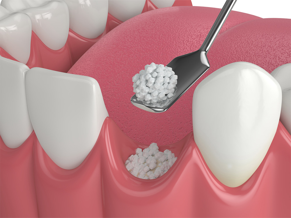 3d rendering of a gum graft being applied to a tooth on the bottom row