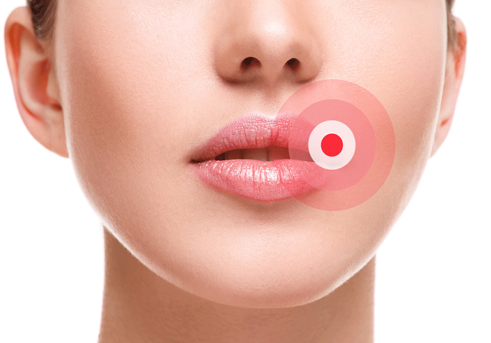 Close-up of a woman's lower face showing her lips with a red target overlay highlighting a cold sore, emphasizing medical or cosmetic focus on oral health issues