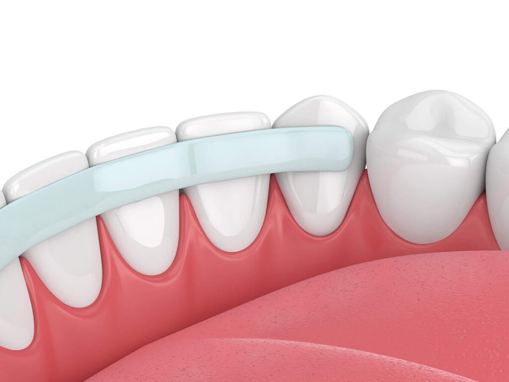 Close-up 3D illustration showing a light blue dental bonding strip applied to the upper front teeth to correct imperfections, with detailed view of the tooth surfaces and pink gums, set against a pale background.