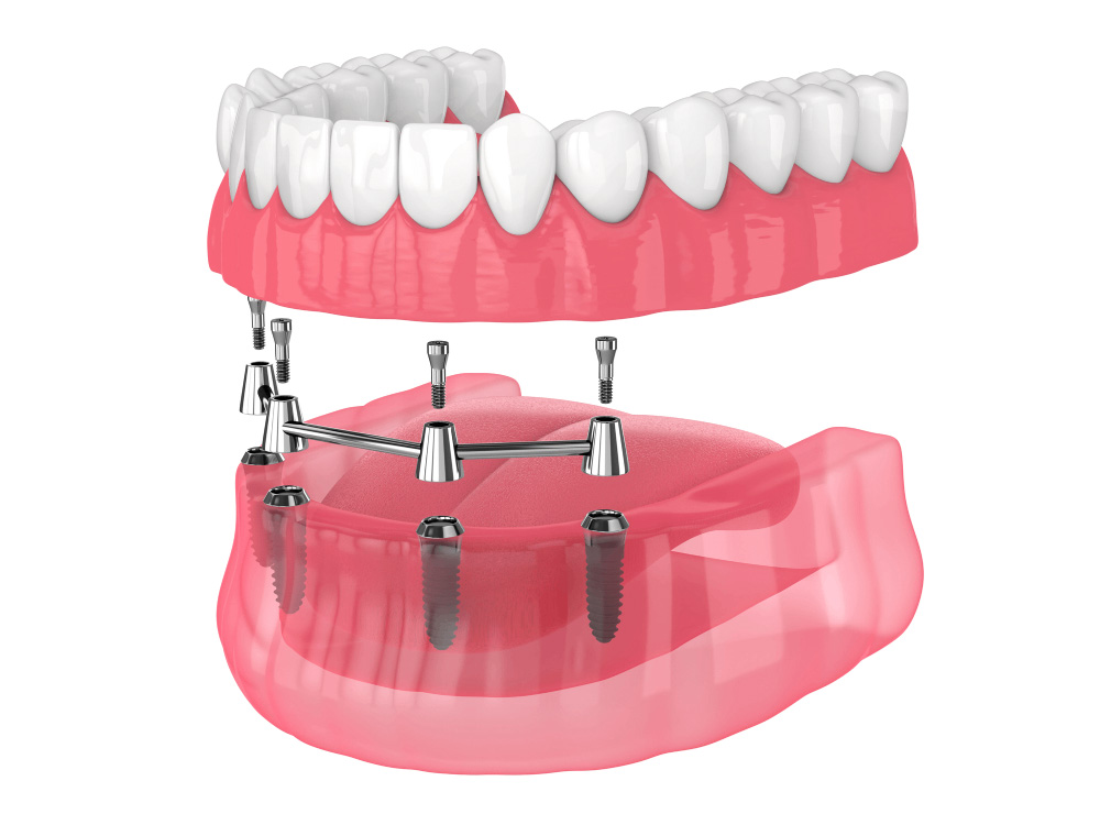 3D illustration of an 'All-On-4' dental implant model with transparent pink gums showing a full set of white upper and lower teeth supported by four implants in each jaw, demonstrating advanced dental restoration technology.