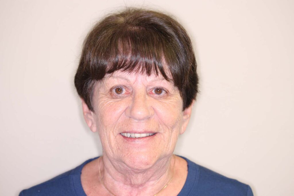Full mouth dental implant before photo.