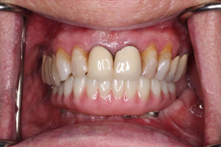 Full mouth dental implants after photo.
