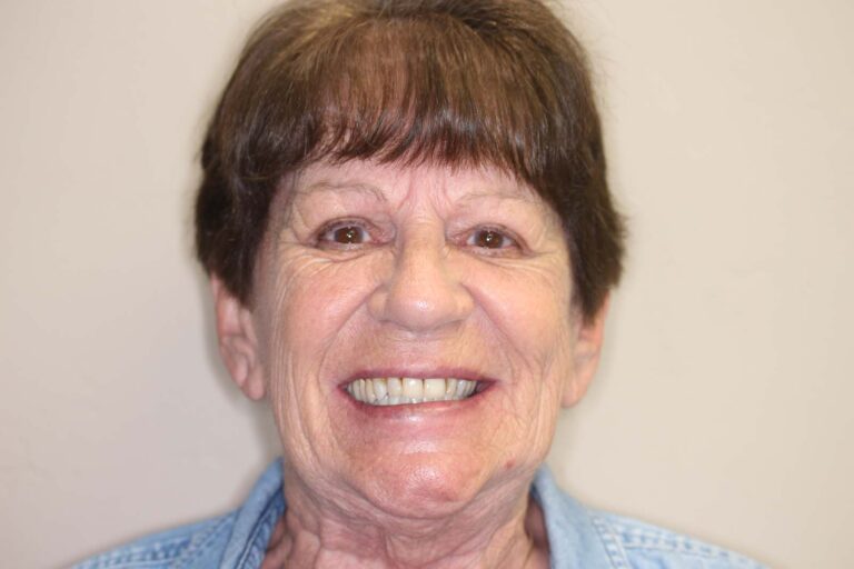 Full mouth dental implants after photo.