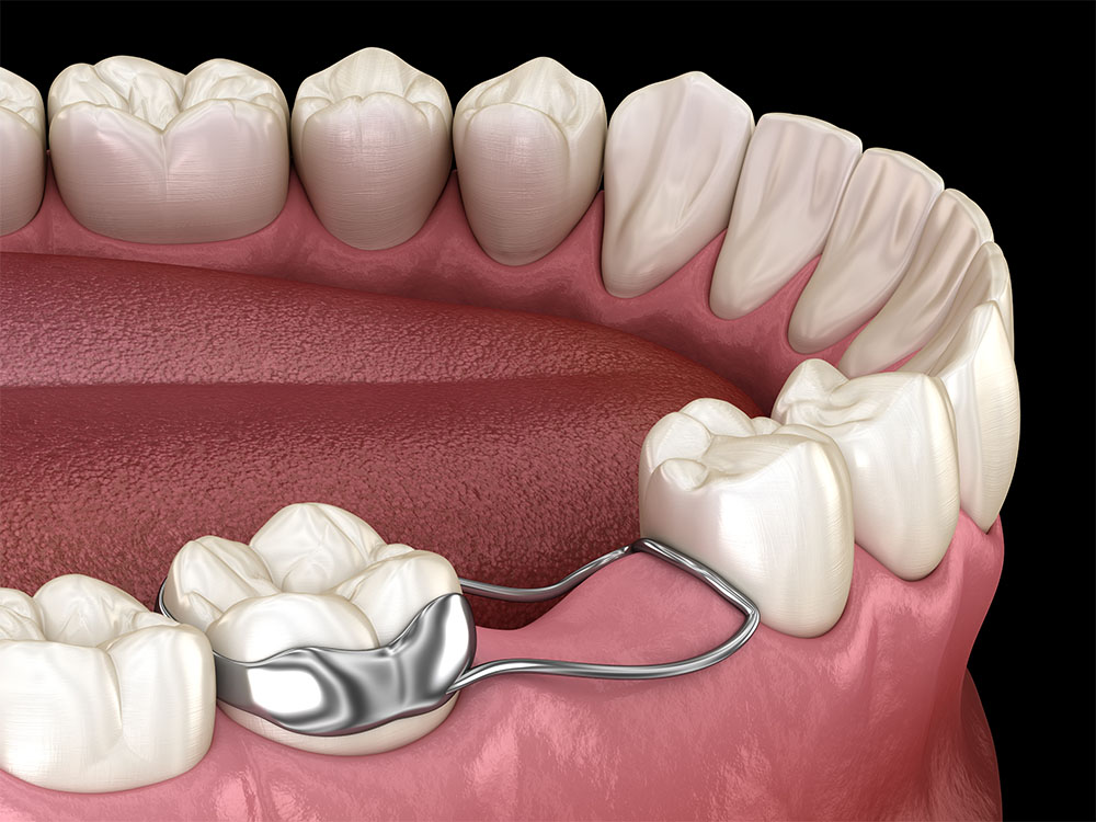 3D illustration of a lower dental arch with a metallic space maintainer installed on the left side to preserve the space for future permanent teeth, set against a dark background, emphasizing dental care for missing teeth.