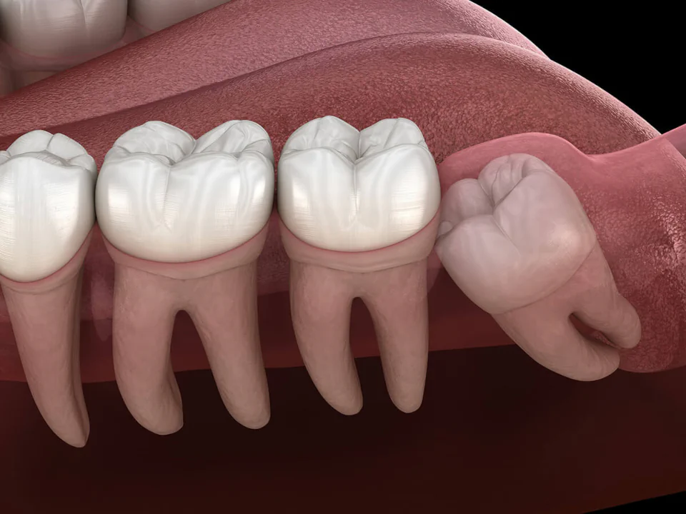 Wisdom teeth removal in Greenville, WI at Westhill Dental.