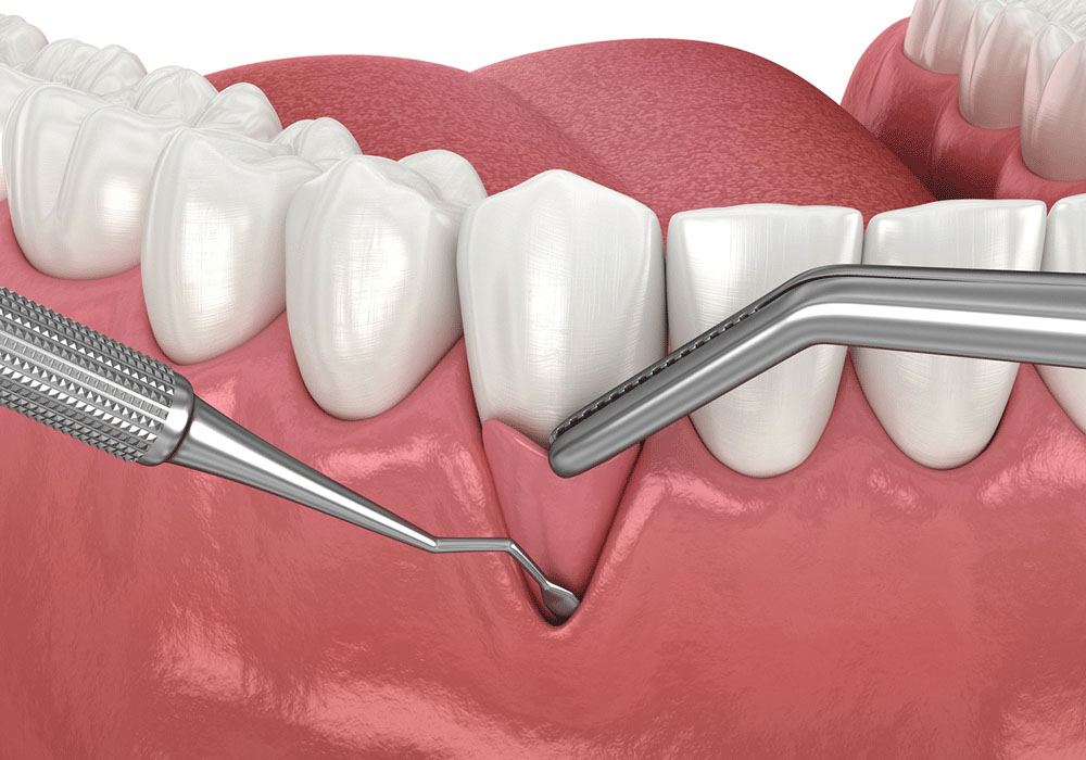 D illustration of dental health care showing a close-up view of a dental probe checking gum health near the lower molars, emphasizing the need for gum disease treatment, set against a pink gum background.