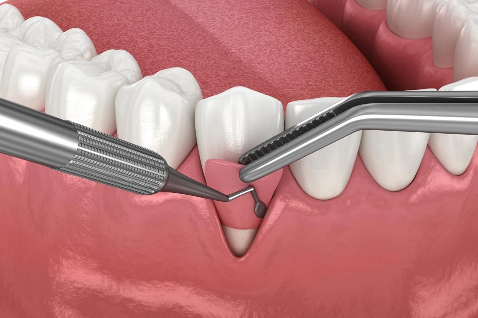 Gum grafting dental services in Greenville, WI at Westhill Dental.