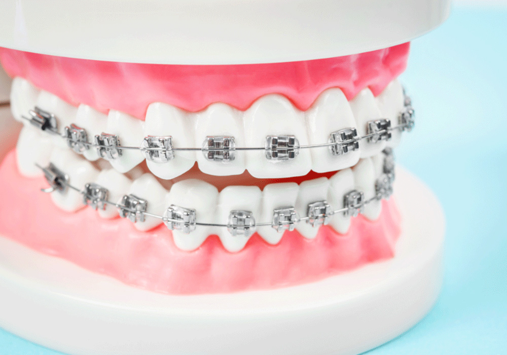 Detailed model of a set of teeth with metal braces on both upper and lower jaws, demonstrating orthodontic alignment devices on artificial gums, set against a soft blue background.
