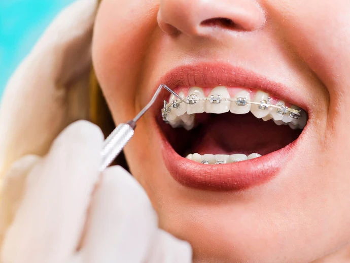 Metal braces in Greenville, WI at Westhill Dental.